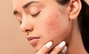 Acne and acne scarring
