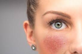 Redness and rosacea